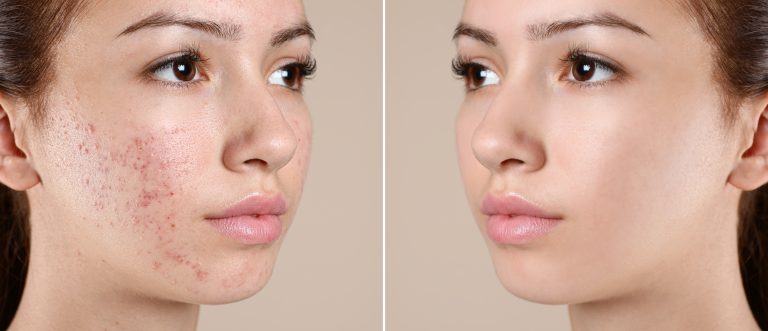 Pore Cleaning Device