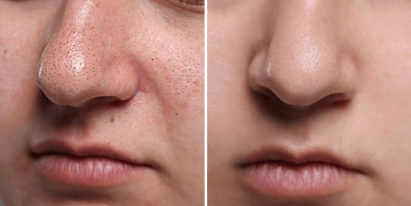 Pore Cleaning Device